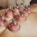 Cupping Therapy in Brighton